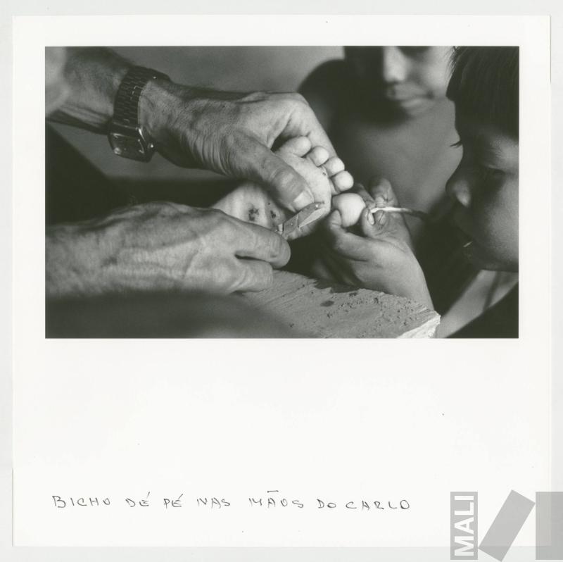 Bicho dé pé nas mãos do Carlo