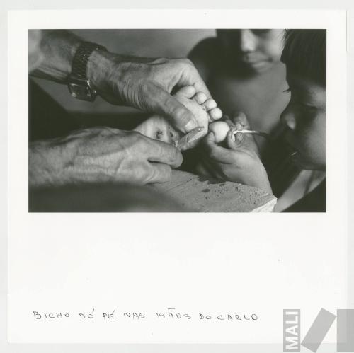 Bicho dé pé nas mãos do Carlo