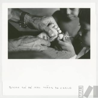 Bicho dé pé nas mãos do Carlo